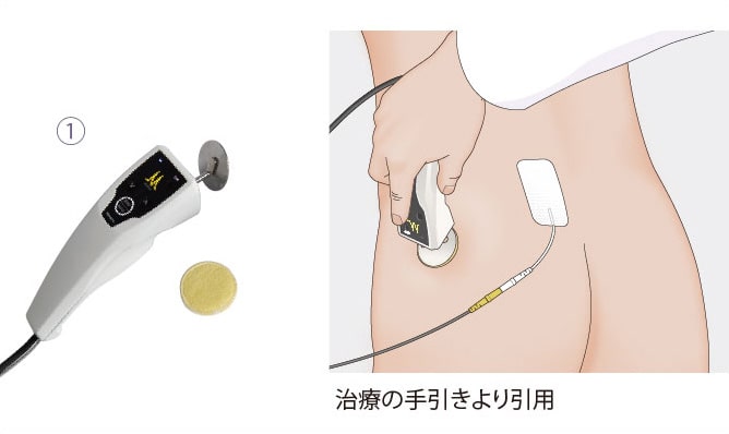 高電圧治療